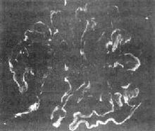 肾小球肾炎 肾小球肾炎