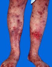 大疱性表皮松解 大疱性表皮松解