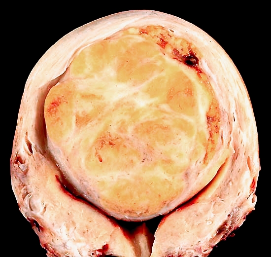 leiomyoma
